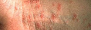 scabies-rash-pictures-2